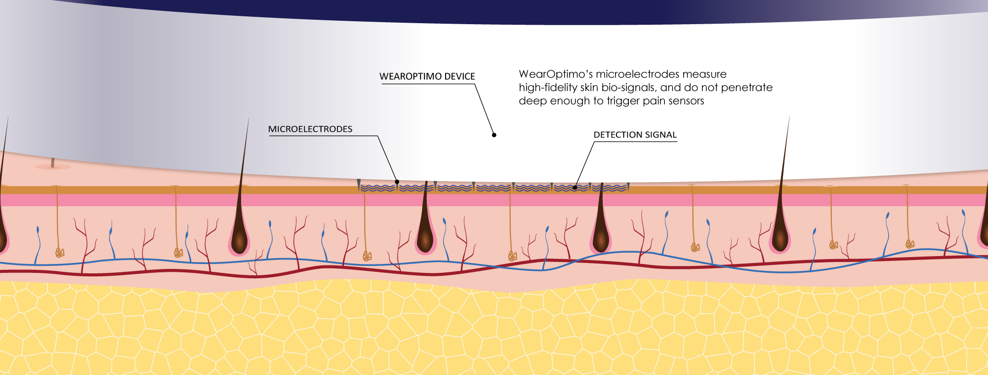 WearOptimo’s microelectrodes measure high-fidelity skin bio-signals, and do not penetrate deep enough to trigger pain sensors.